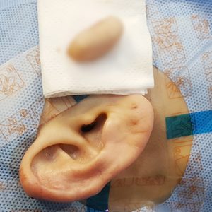 귀 켈로이드 수술 직후 사진